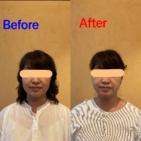 美容患者4