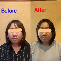 美容患者8