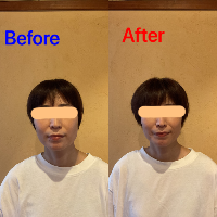 美容患者9